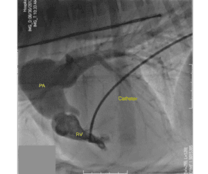 how long will my dog live with pulmonic stenosis